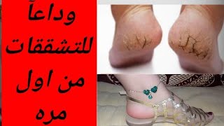 علاج تشققات القدمين بوصفه منزليه سريعه ونتيجه مجربه 100%