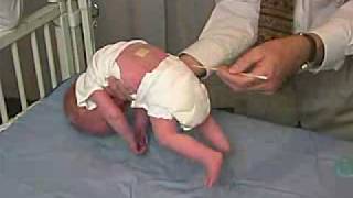 Neurology Exam Newborn-Abnormal Primitive Reflexes - Galant
