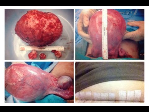 que-son-miomas-o-fibromas,-tratamiento,sintomas,-cirugías,alimentos-que-no-debes-consumir,