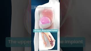 Breast Implant Placement Options &amp; Benefits