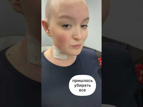 Сбрила волосы! #лимфома #химиотерапия #онкология #допосле #личныйопыт #прическа
