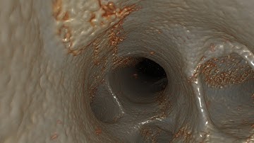 Distal Lung from microCT - 5 micron resolution