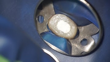 Root Canal Filling using MTA