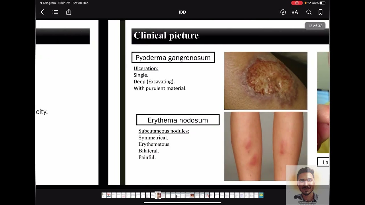 Inflammatory bowel Disease Dr Moataz Mahmoud