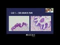 Through-the-needle Biopsy of Pancreatic Cystic Lesions - ACG 2020 Presentation