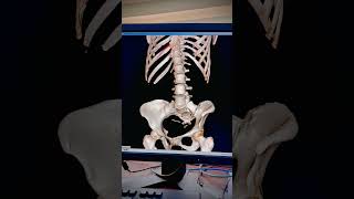 Scoliosis spine : 3D CT Scan Analysis #ctscan #mriscan #viralvideo #toptrending #highlight