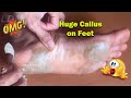 Callus Removal From Feet - 足からのカルス除去＃57