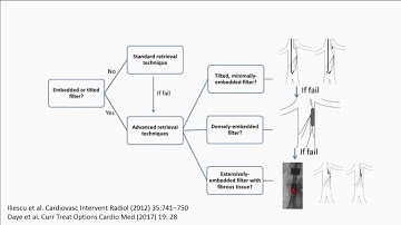 Complex IVC Filter Retrieval - Tallia Rousan, MD