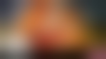 Proximal Humerus Four-Part Fracture: Reverse Shoulder Replacement.