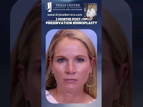 Video thumbnail: ✨ Preservation Rhinoplasty | 3 Months Post-Op #Rhinoplasty  #FacialPlastics #BeforeAndAfter