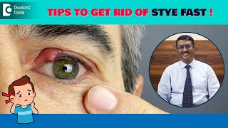 Bump on Eyelid | Stye Eye Treatment | Stye Prevention Tips  – Dr. Sriram Ramalingam| Doctors' Circle