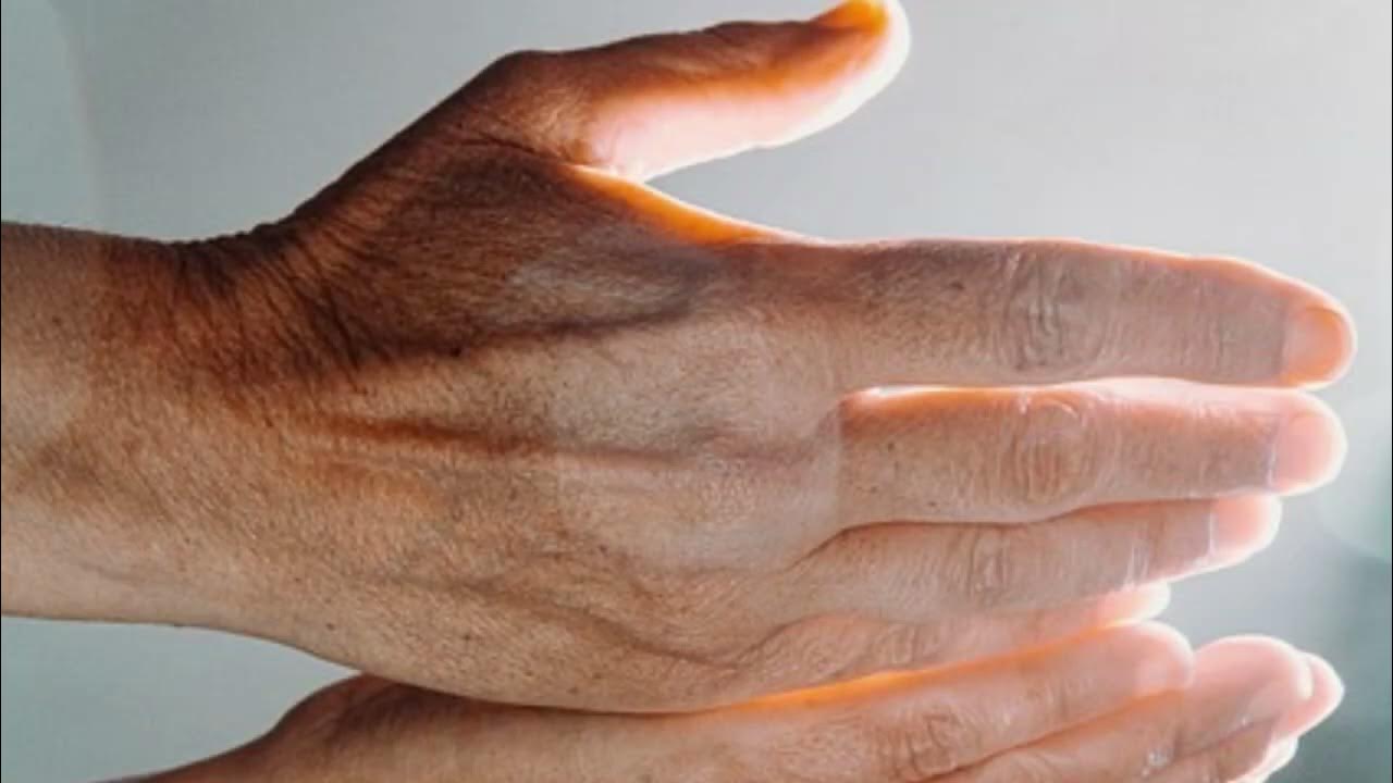 Желтые пальцы на руках причины. Клинодоктилия мкзинца. Немеют пальцы на руках причины. Желтые пальцы на руках причины. Ониходистрофия - онихолизис.