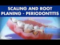 Treatment of periodontal disease - Scaling and root planing - Tartar ©