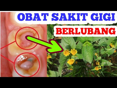 Obat sakit gigi berlubang paling ampuh 
