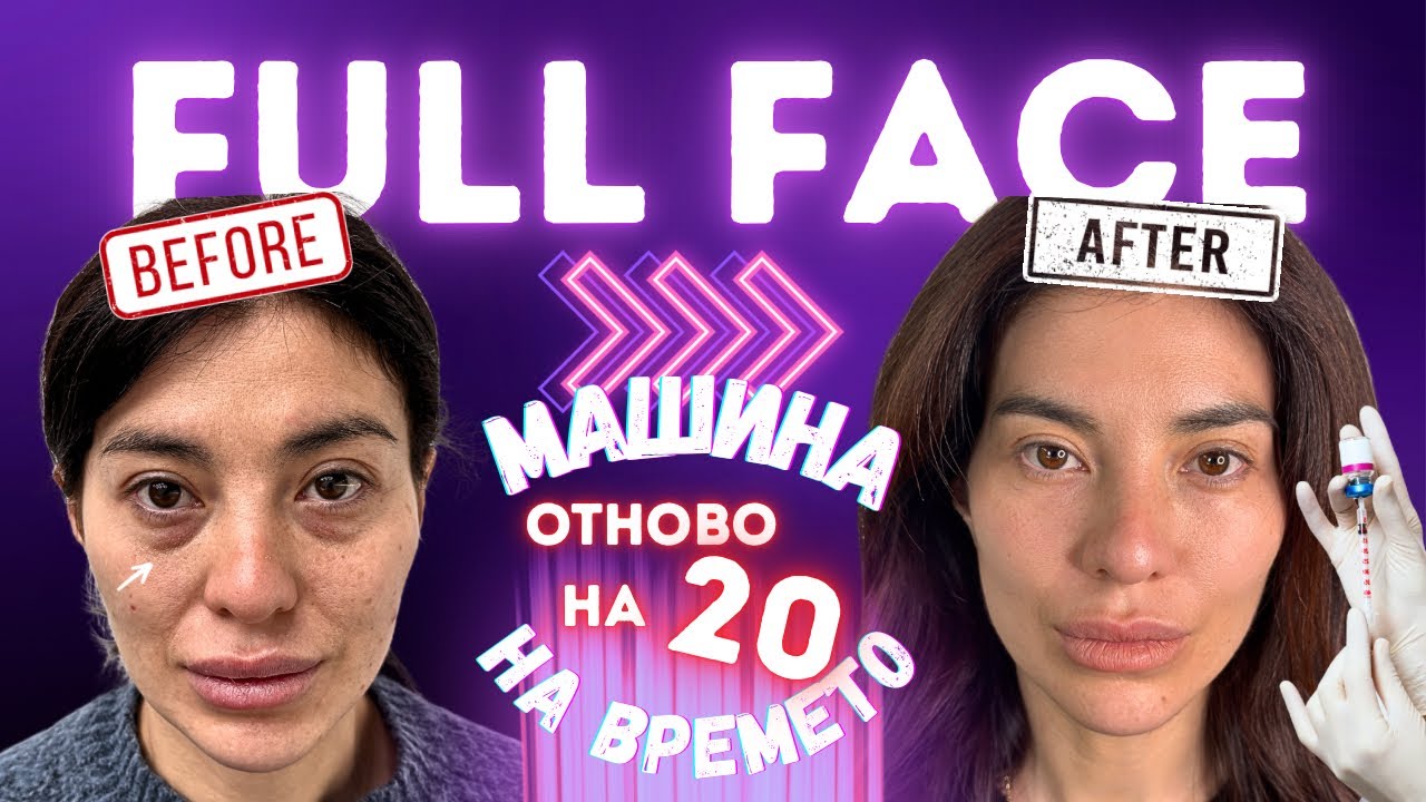 НЕОЧАКВАН РЕЗУЛТАТ😮 сравним с ОПЕРАТИВНА БЛЕФАРОПЛАСТИКА🤯