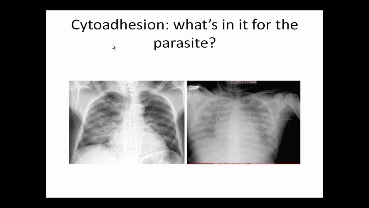 Internal Medicine Grand Rounds Malaria Sickle Cell Disease Links 