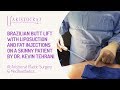 Brazilian Butt Lift with Liposuction and Fat Injections on a Skinny Patient by Dr. Kevin Tehrani