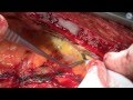 Off-pump coronary artery bypass grafting using skeletonized in situ arterial grafts
