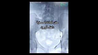 علاج دوالي الخصية بدون جراحة | قسطرة دوالي الخصية | د. أحمد الطاهر