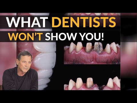 Teeth Grinding (Dentists Never Talk About It)! | Brighter Image Lab Can