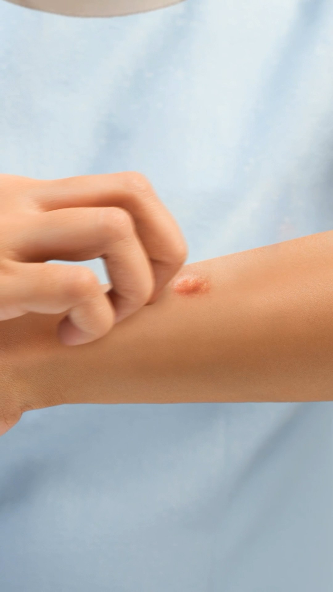 ¿Por qué los mosquitos dejan ronchas? ? #xpresstv