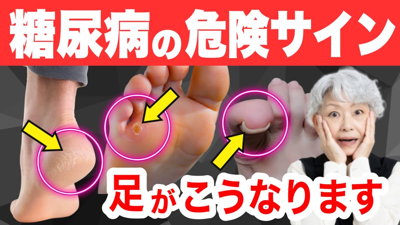 【知らないと後悔】糖尿病「足」の危険サイン。糖尿病は知らないうちに進行しています!