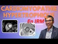 Cardiomyopathie hypertrophique en irm  cas clinique de dcouverte de cmh