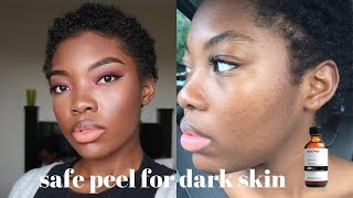 chemical peel at home for dark skin | chemical peel at home for acne