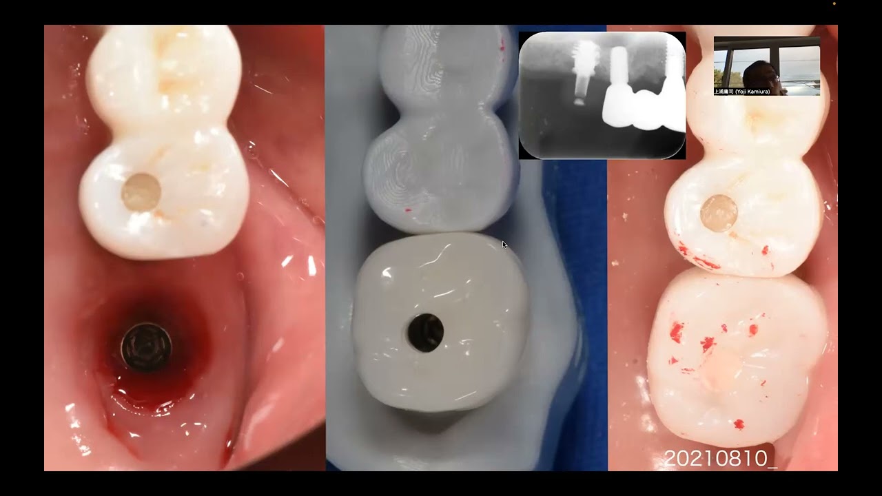 【極美品】Terrell L. Root症例集　Terrell L.Root Amazon.co.jp: Terrell L. Root症例集 : Terrell L.Root, 川本