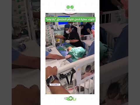 عاجل انتهاء عملية فصل التوأم السعودي الملتصق يارا ولارا 