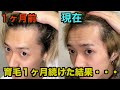 [育毛1ヶ月目] 育毛剤を使いつづけてどれほど効果が出たか教えます！！