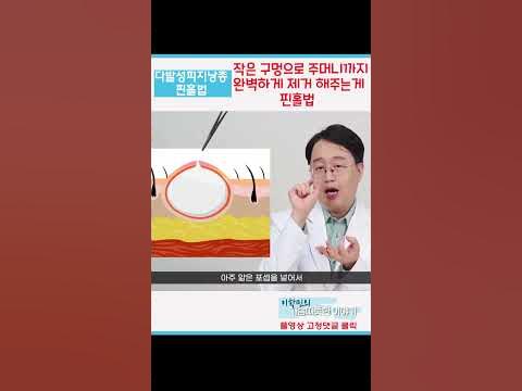다발성피지낭종 핀홀법 #다발성피지낭종 #다발성피지낭종제거 #핀홀법 - Youtube