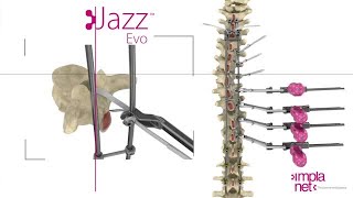 Implanet:Jazz Evo Implants