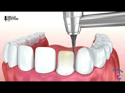 Dental Veneers Procedure Animation | Hello Doctor Talks