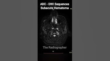 ADC DWI Sequences of Subacute Hematoma |