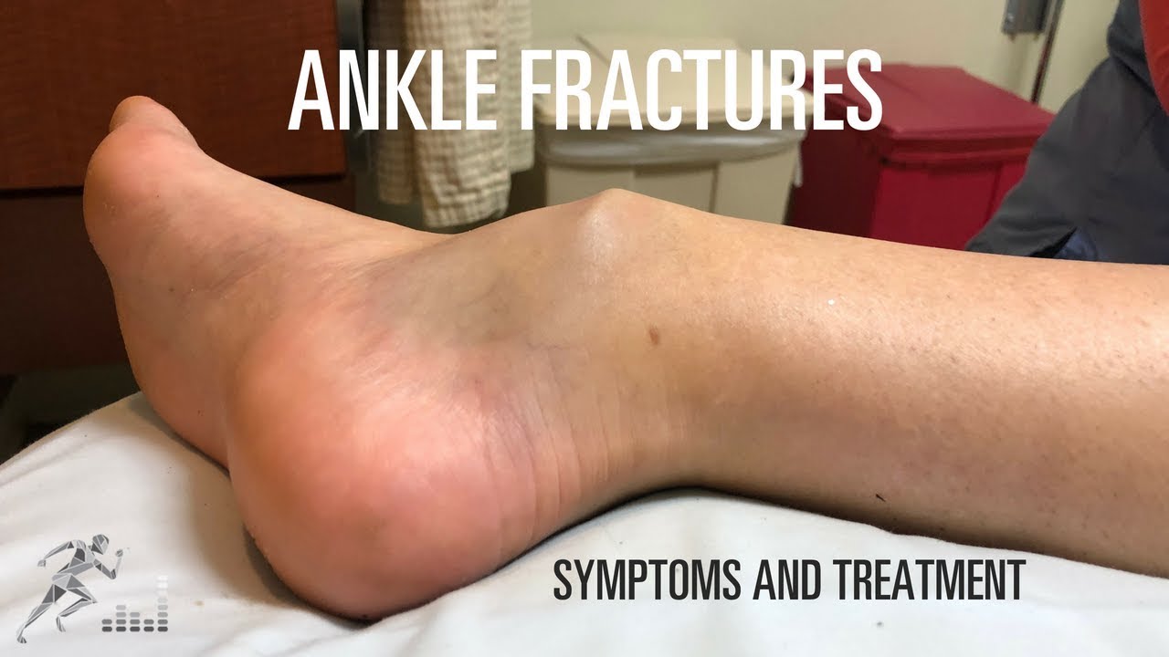 Ankle fracture Types, signs and symptoms and treatment YouTube