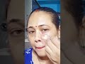 #shorts#shortvideo#hyperpigmentation#melsma#hyperpigmentationtreatment
