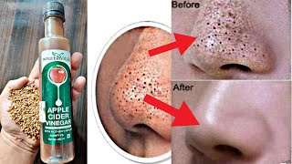 2 दिन में ही चेहरे के रोम छिद्र हमेशा के लिए गायब हो जाएंगे | Get Rid of Open Large Pores in 2 Days