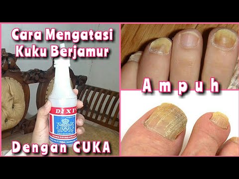 Video: Cara Menyembuhkan Jamur Kuku: Bisakah Cuka Membantu?