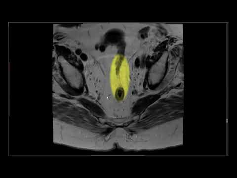 Video: Amiloīdās Patoloģijas Prognozēšana Kognitīvi Netraucētiem Indivīdiem, Izmantojot Smadzeņu Garenvirziena Struktūras MRI Analīzi Pēc Vokseļiem