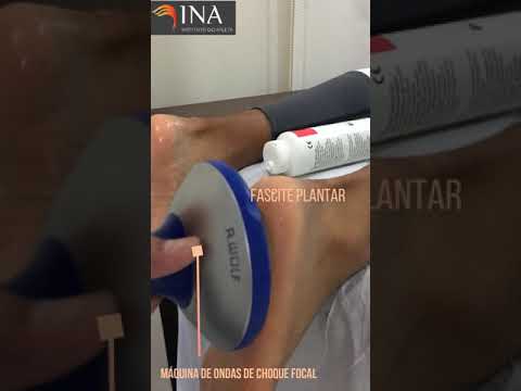 ONDAS DE CHOQUE PARA FASCITE PLANTAR