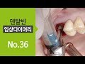 [#Dentalbean] Upper posterior immediate implant placement with SQ fixture and Septum drill kit]