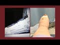 My midfoot fusion surgery part 5