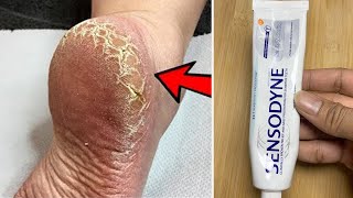 Eliminate Cracked Heels and get White and Smooth Feet \/ Magic Cracked Heels home remedy