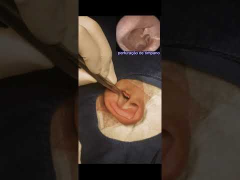 Vídeo: A timpanoplastia pode causar perda auditiva?