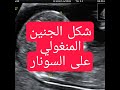 كيف يعرف الطبيب ان الجنين مصاب بمتلازمة داون صور السونار للجنين المصاب بالمنغولية 