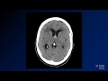 Neuroradiology board review lecture 1 case 11