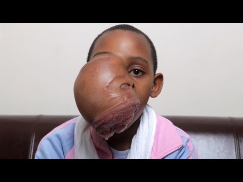 Unbelievable Face Tumour Girl