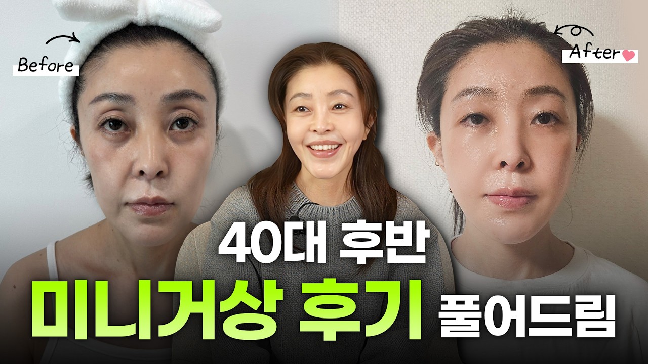 미니거상 잘하는 곳 찾는다면? 40대 불독살 제거와 꺼진 눈 지방 이식으로 10살 어려 보이는 법 (디에이성형외과)