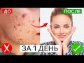 7 ПРОСТЫХ СПОСОБОВ для идеальной кожи БЕЗ ПРЫЩЕЙ..